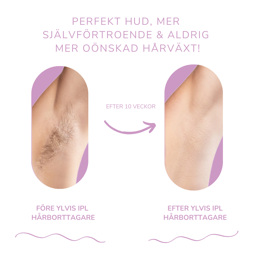 LysaSkin™ – Smärtfri släthet, varaktigt självförtroende