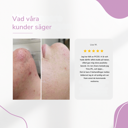 LysaSkin™ – Smärtfri släthet, varaktigt självförtroende